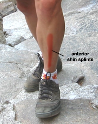 Shin Splints Symptoms
